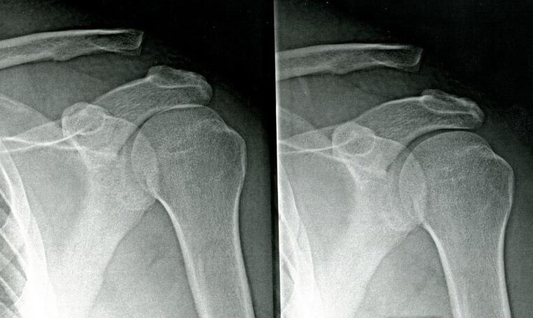 Fracture clavicule