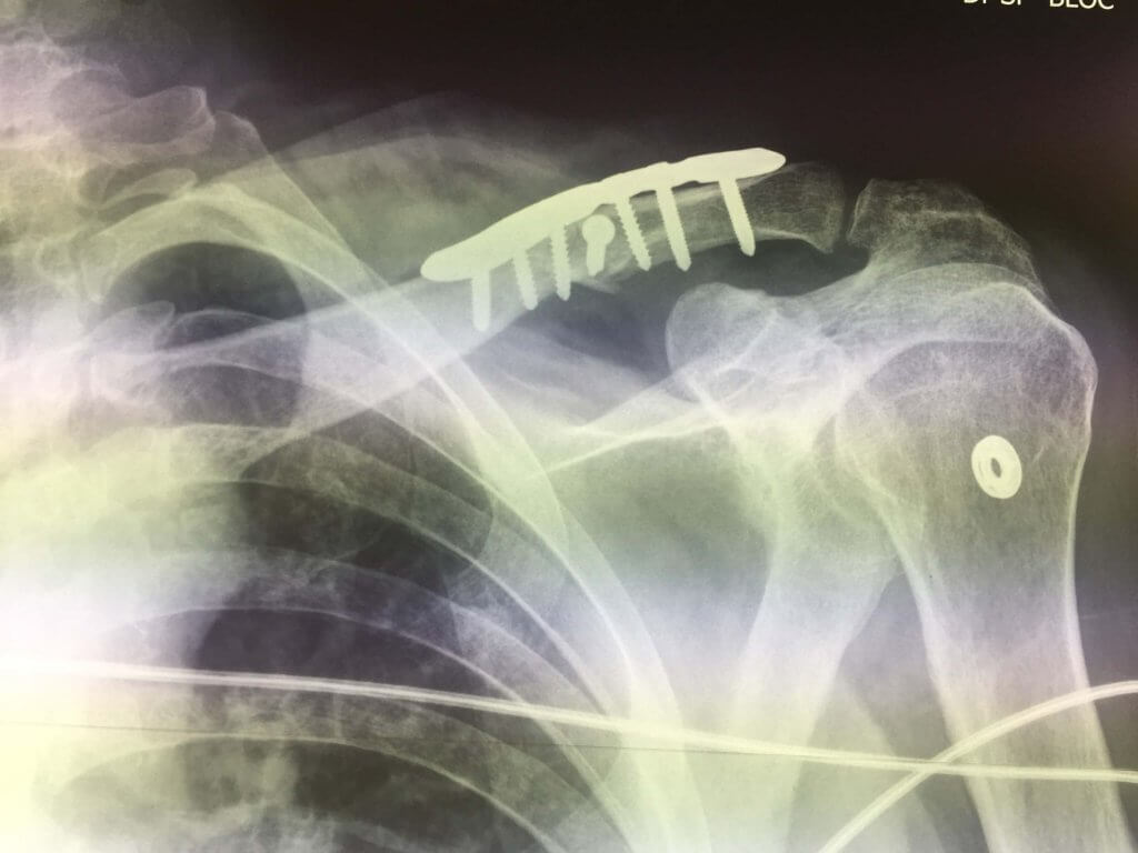 Suite De Fracture En 3 Lettres