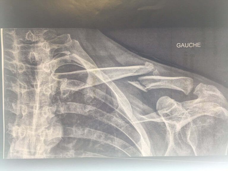 Fracture de la clavicule GENA